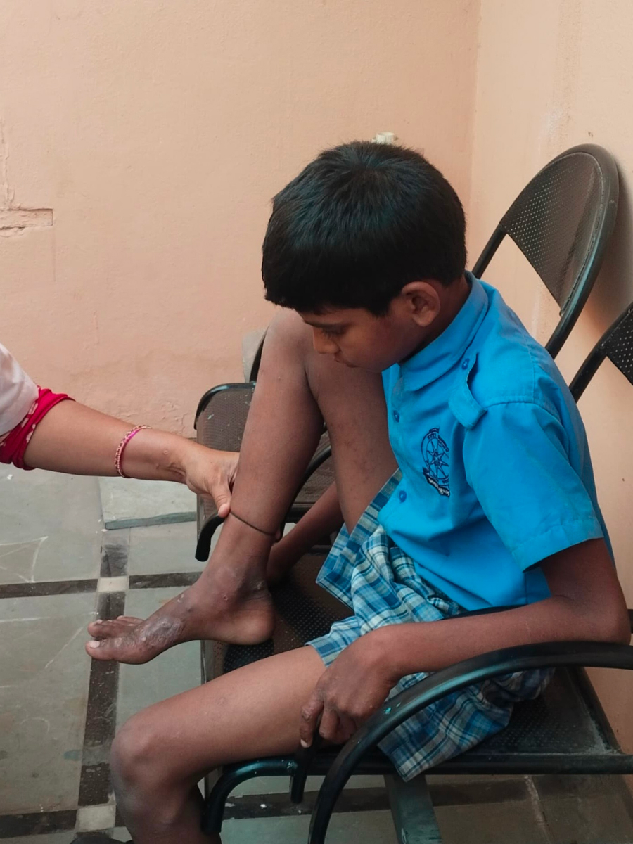 Ranveer Before Treatment